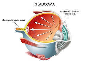 Chuẩn đoán bệnh Glaucoma