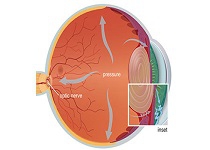 Dấu hiệu và triệu chứng bệnh Glaucoma